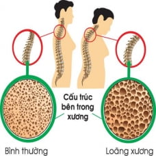 4 nguyên nhân tàn phá xương khớp khủng khiếp, đáng tiếc là dân văn phòng vẫn làm thường xuyên